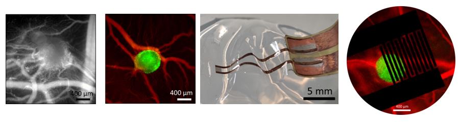 Oncoelectronics